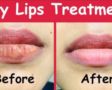 Dry Lips: 9 Excellent Natural Home Remedies