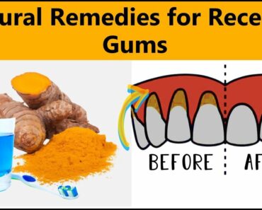 Receding Gums: Excellent Home Remedies