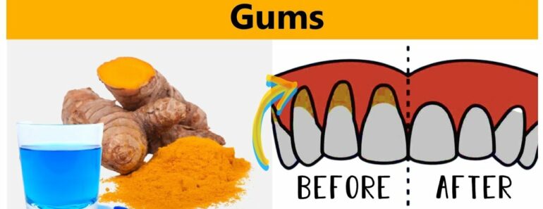 Receding Gums: Excellent Home Remedies