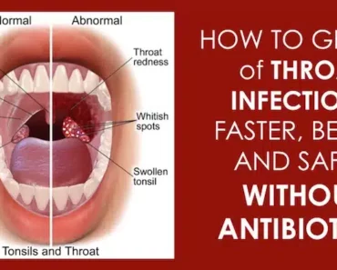 12 Effective Natural Home Remedies To Treat A Strep Throat Infection