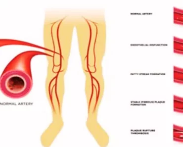 6 Simple Ways You Can Unclog Your Arteries Naturally