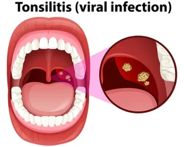 The Greatest Natural Home Remedies for Tonsillitis You Didn’t Knew About