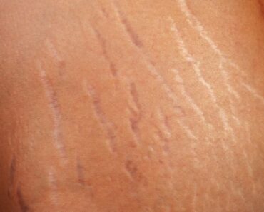 Here Are Tips On How To Get Rid Of Your Stretch Marks Naturally