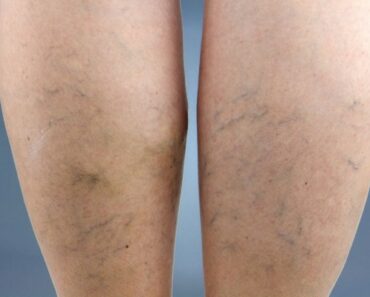 Natural Remedies for Varicose Veins