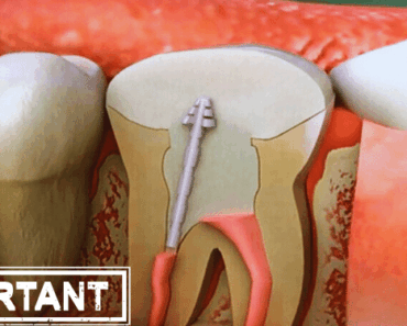 How Root Canal Procedures May Increase Your Risk of Chronic Disease?