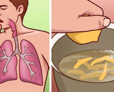 Top 10 Home Remedies to Help With Bronchitis and Painful Coughing Attacks