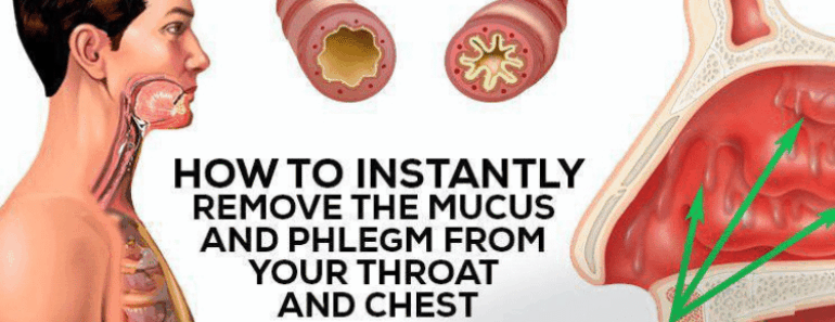 How to Naturally Eliminate Phlegm and Mucus From Your Chest and Throat—Fast and Effectively!