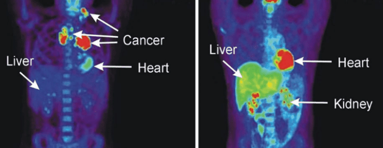 9 Warning Signs That Anounce Cancer May Be Growing in Your Body