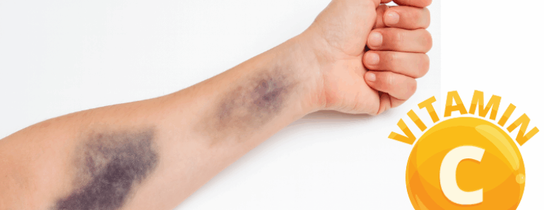 Your Body Might Be Low in Vitamin C – Here Are 9 Subtle Warnings You Shouldn’t Ignore