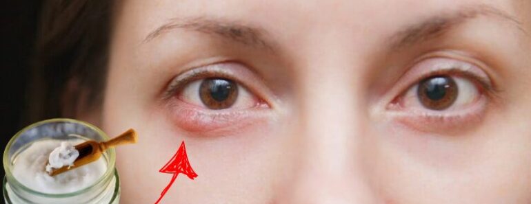 She Rubbed Coconut Oil Around Her Eyes—5 Minutes Later, The Results Left Everyone Stunned!