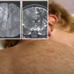 Sacramento Health Officials Warn of Growing Measles Risk After 7-Year-Old Boy Dies From Rare Brain Condition Linked to Infection as a Baby