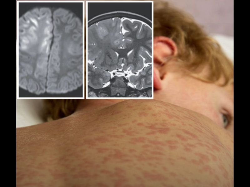 Sacramento Health Officials Warn of Growing Measles Risk After 7-Year-Old Boy Dies From Rare Brain Condition Linked to Infection as a Baby