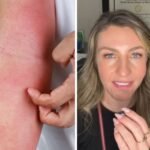 New Ringworm-Based STD TMvii Spreading Across the US &mdash; Dallas Doctor Warns It Is Being Misdiagnosed and Flying Under the Radar