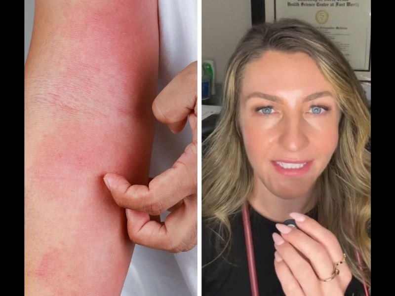 New Ringworm-Based STD TMvii Spreading Across the US &mdash; Dallas Doctor Warns It Is Being Misdiagnosed and Flying Under the Radar