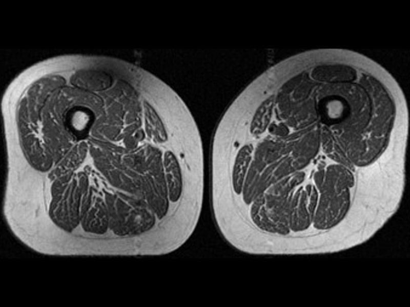 Ultraprocessed Foods Turning Thigh Muscles Into Fat-Marbled Tissue — New Study Links Daily Diet Choices to Serious Muscle Damage Across the United States